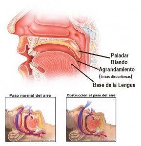 paladar_roncador_varios