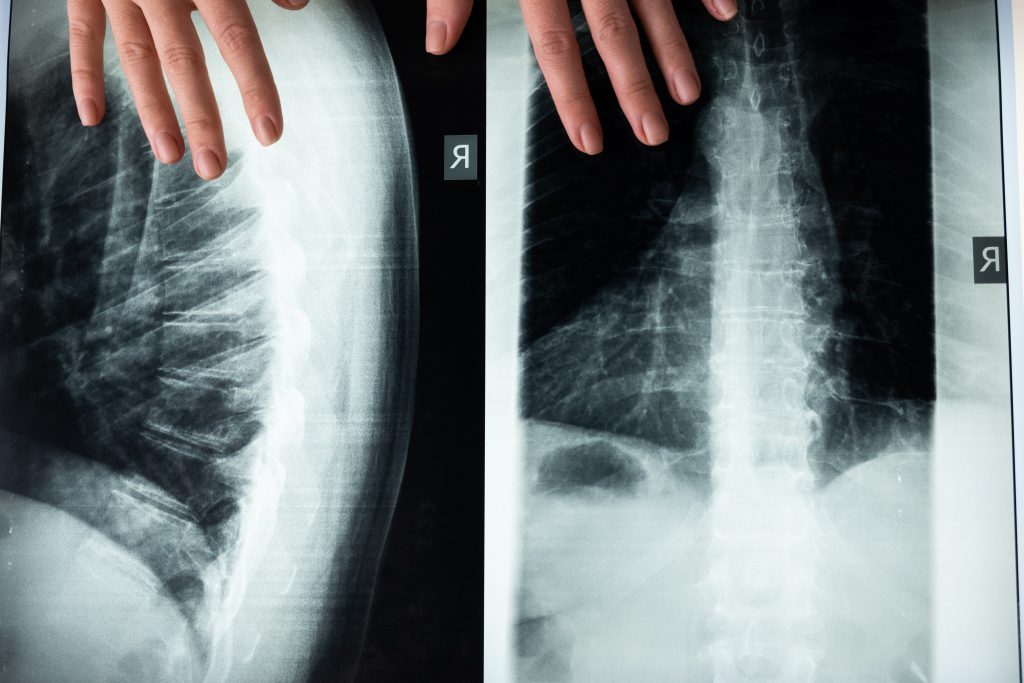 colchones para escoliosis